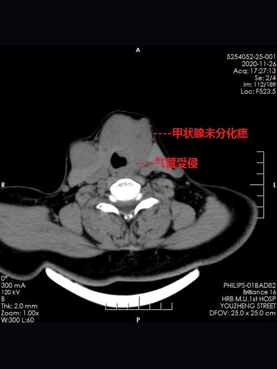 甲状腺未分化癌.jpg