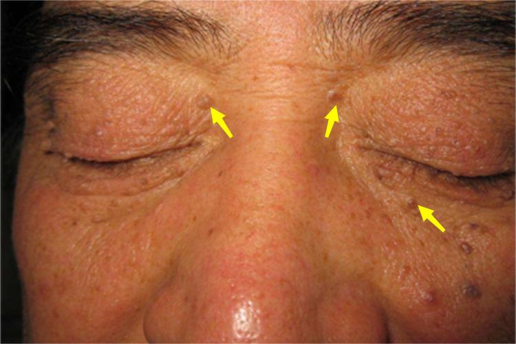 软纤维瘤眼周症状图 软纤维瘤眼周症状图