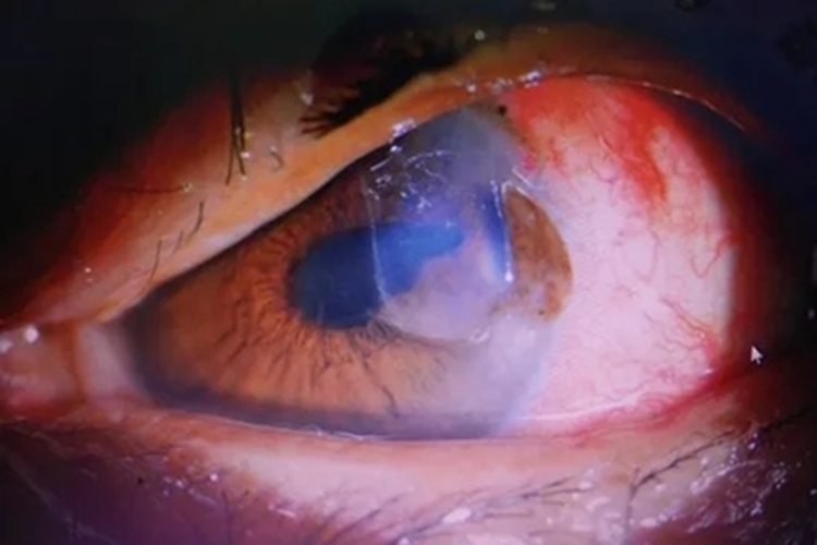 外伤性白内障红肿图 外伤性白内障红肿图