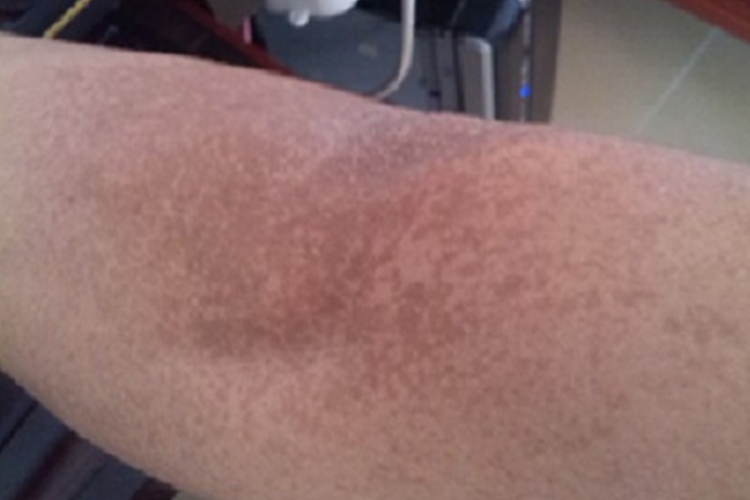 利什曼原虫病症状图 利什曼原虫病症状图