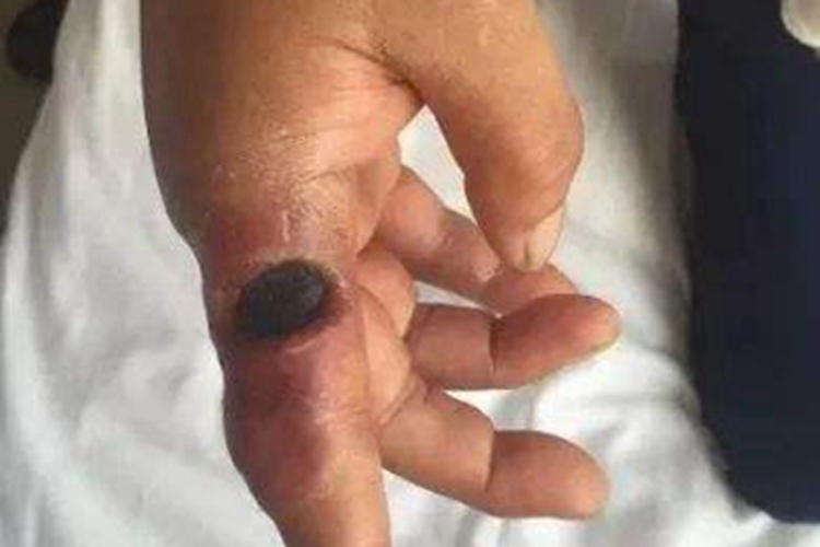 皮肤炭疽手指结痂图