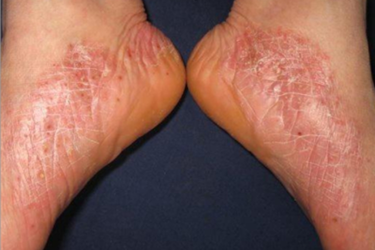 足浅表性大疱性脓皮病脚部发红图