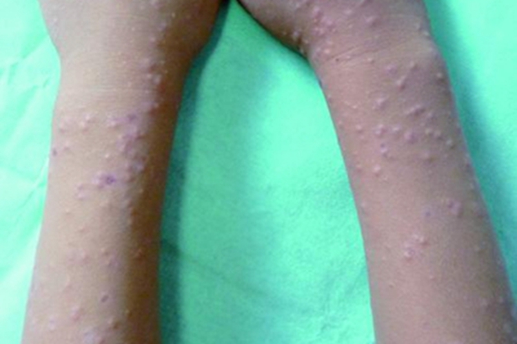 小儿丘疹性肢端皮炎胳膊小疹子图