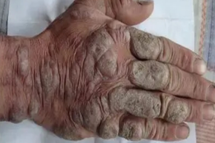 疣状皮肤结核手背症状图