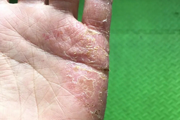 脓疱性细菌疹结痂图