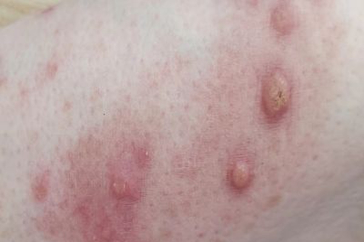 结节性痒疹大腿半球形结节图