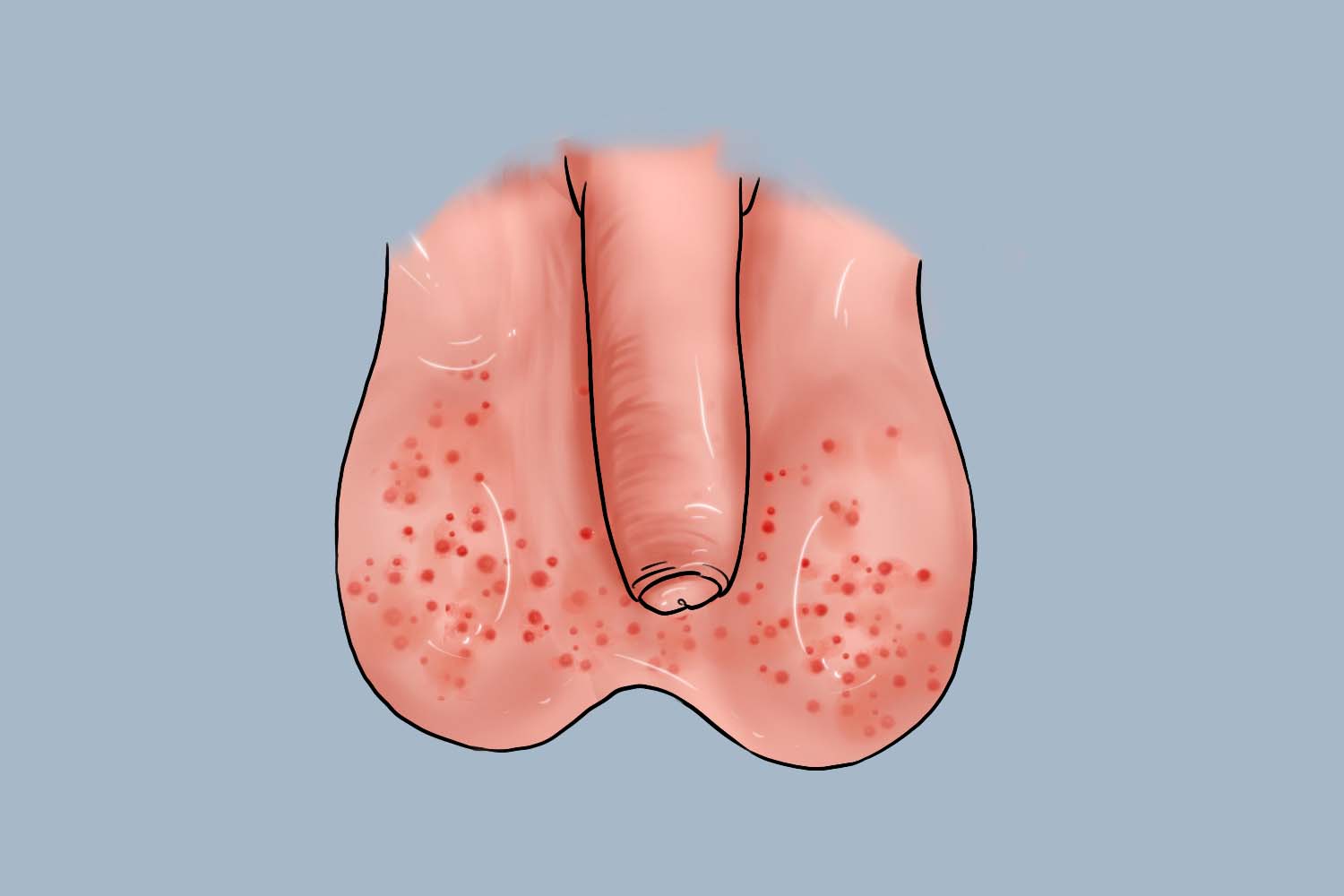 男性阴虱症状图片图库图片