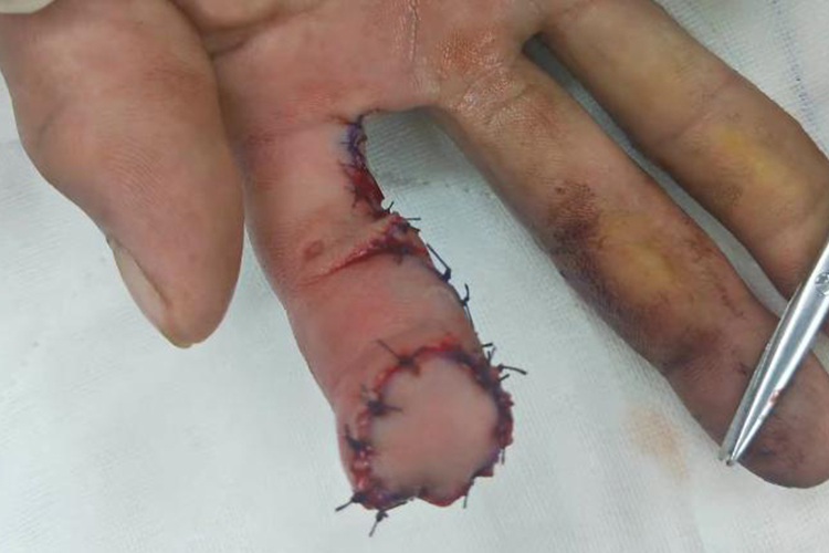 手指末端做皮瓣手术效果图