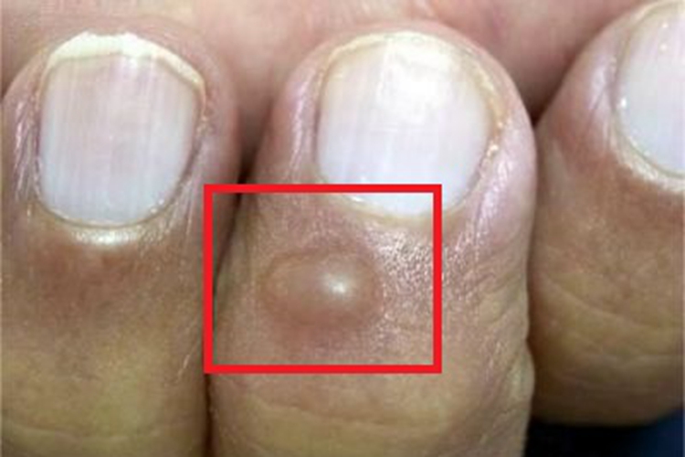 皮肤黏液瘤手指疙瘩图 皮肤黏液瘤手指疙瘩图