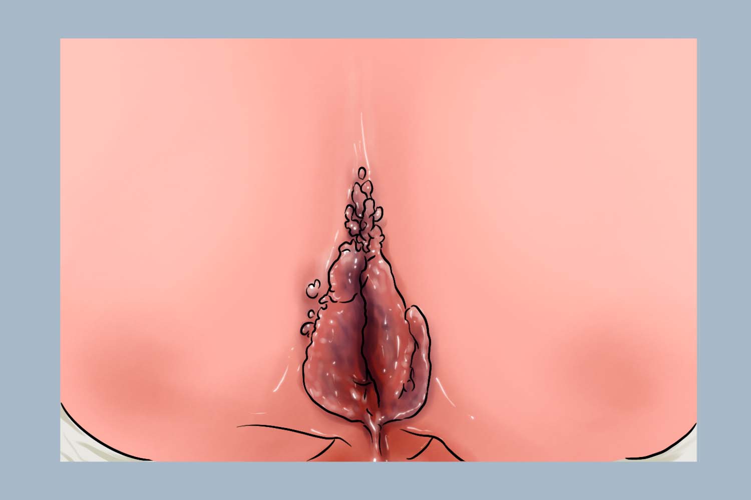 大阴唇尖锐湿疣图