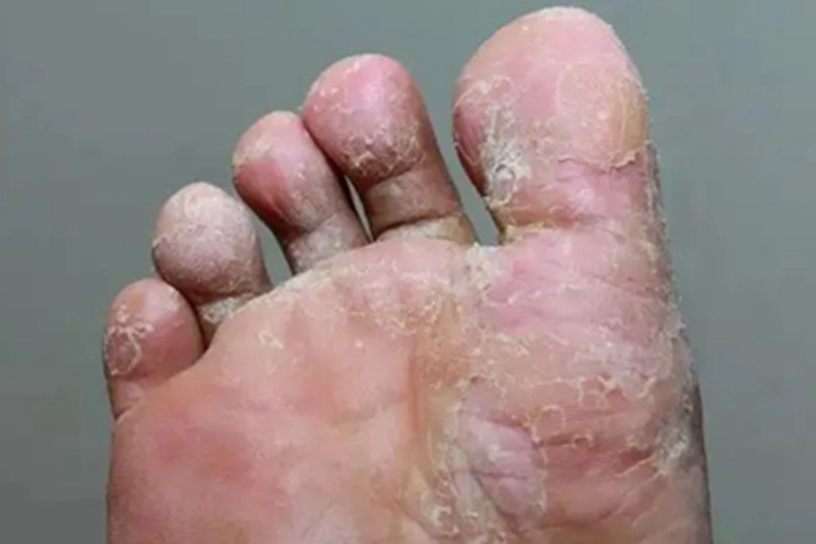 中度糜烂型足癣图