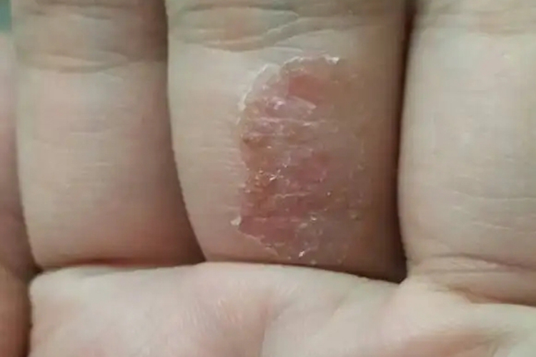 后期带状疱疹图