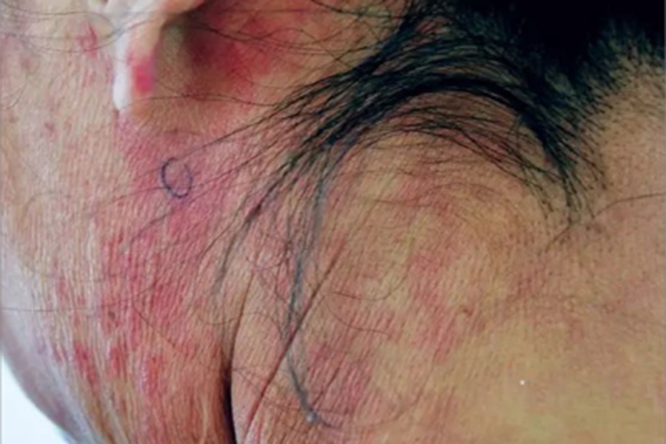 成人Still病耳后红斑图 成人Still病耳后红斑图