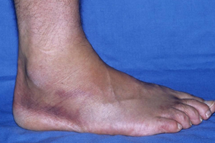 蜂窝织炎脚部皮肤发紫图