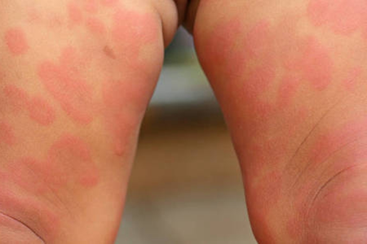 药疹宝宝腿上一片一片红图