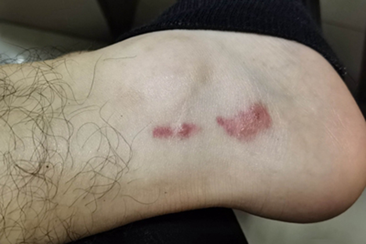 蚊性皮炎脚踝红斑图 蚊性皮炎脚踝红斑图
