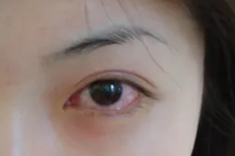 风热赤眼症状图