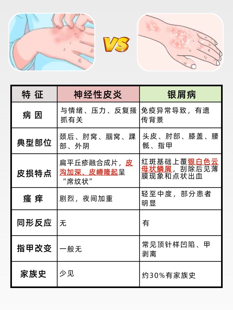 神经性皮炎会误诊为银屑病吗？别踩混淆坑