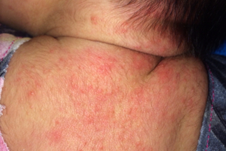 新生儿红痱图