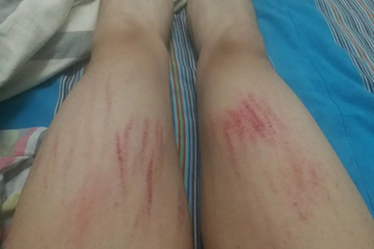 人工皮炎大腿血痂图