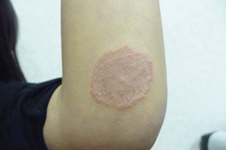 体癣胳膊上有块淡红色斑块图