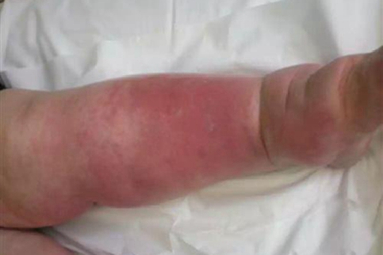 新生儿皮下坏疽症状图