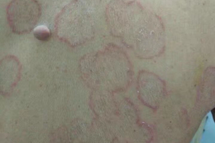 体癣背部红斑图
