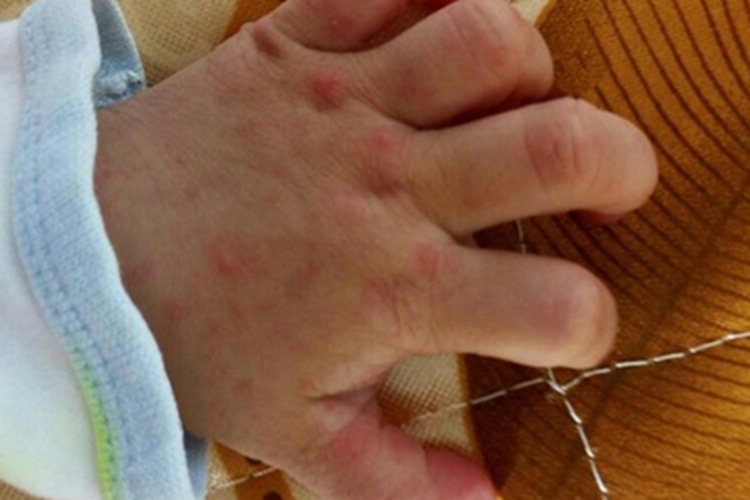 手足口病手部小疙瘩图 手足口病手部小疙瘩图