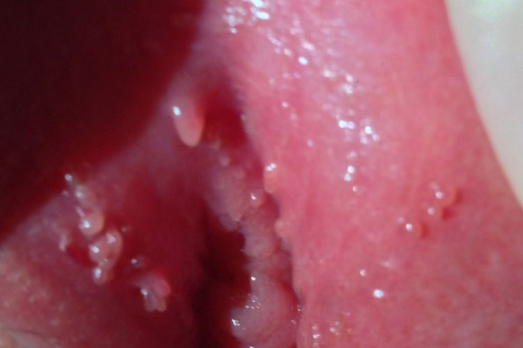 假性湿疣图 假性湿疣图