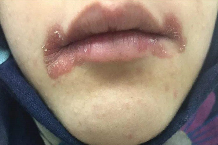 感染性口角炎嘴唇红肿图 感染性口角炎嘴唇红肿图