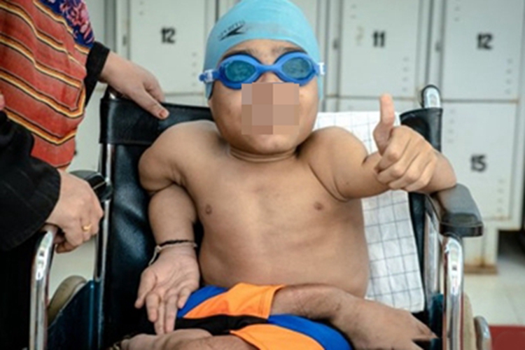 成骨不全骨骼发育畸形图