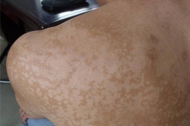 花斑癣后背褐色斑图 花斑癣后背褐色斑图