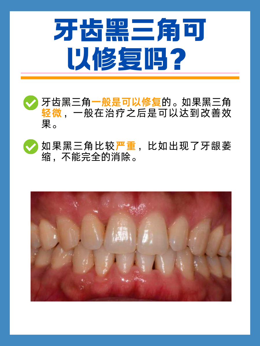 牙齿黑三角可以修复吗？修复方法与预防策略