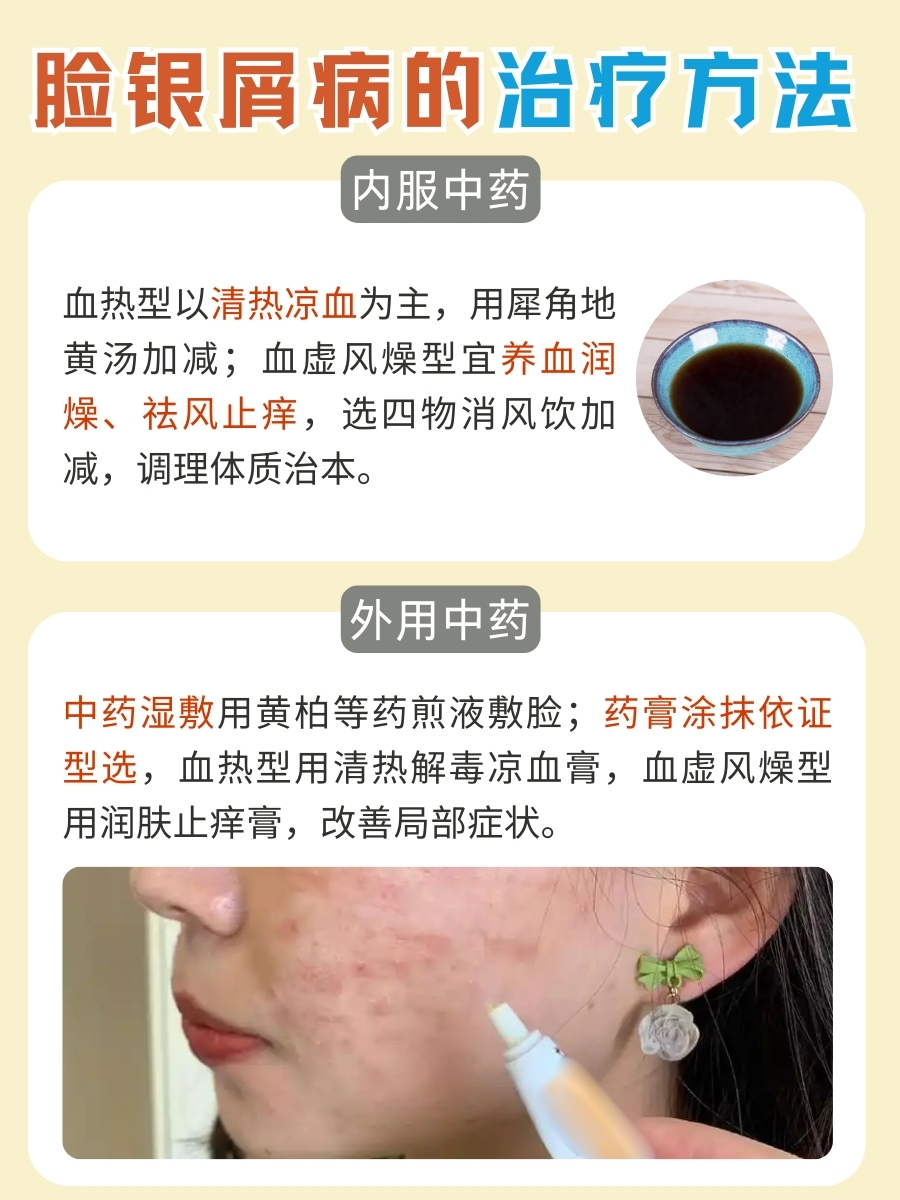快看!脸银屑病,如何治疗能断根?