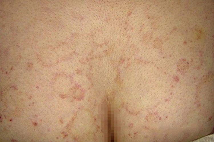 离心性环形红斑臀部症状图