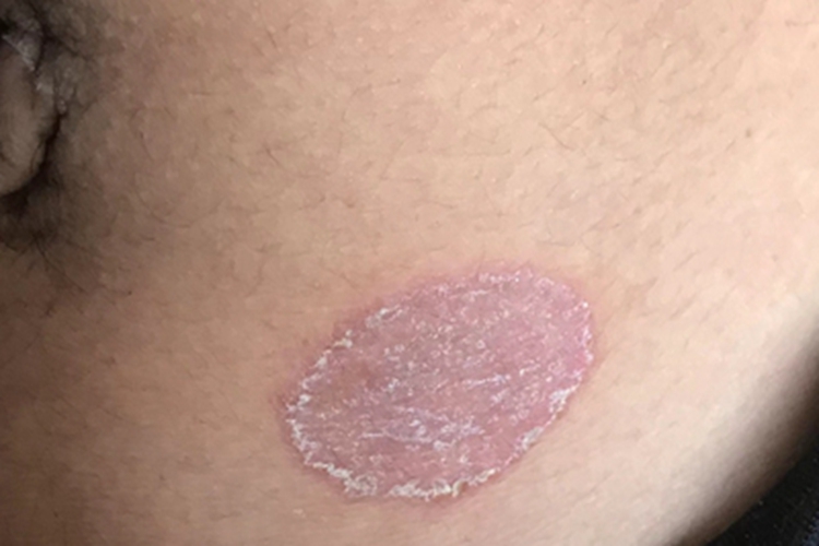 体癣左腹红斑图 体癣左腹红斑图