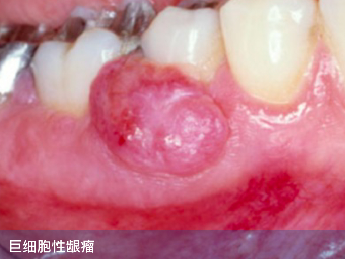 巨细胞性龈瘤