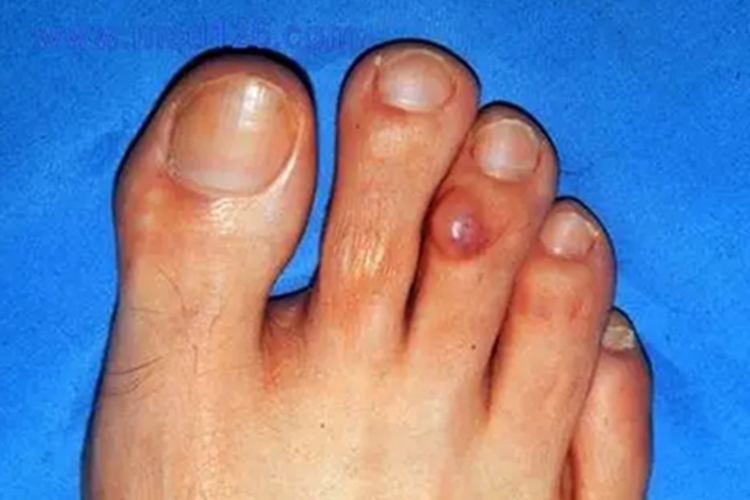 黏液样囊肿脚趾软疙瘩图