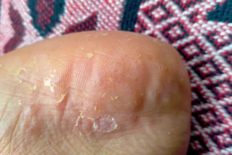 水疱型足癣脚后跟症状图