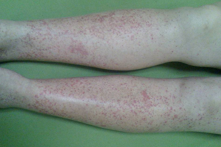 高蛋白过敏瘀点图 高蛋白过敏瘀点图