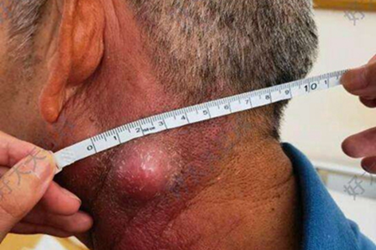 皮肤鳞状细胞癌颈部肿块图