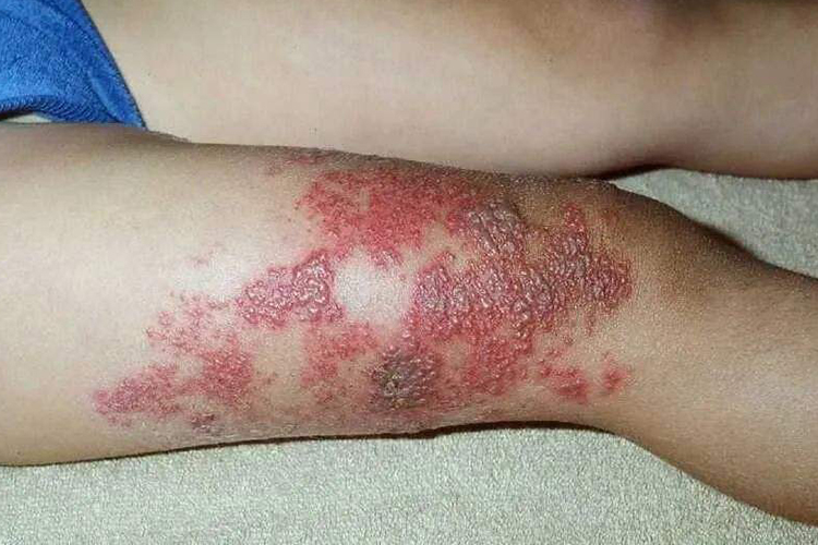 儿童腿部带状疱疹图