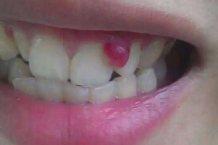 儿童牙龈瘤初期图 儿童牙龈瘤初期图