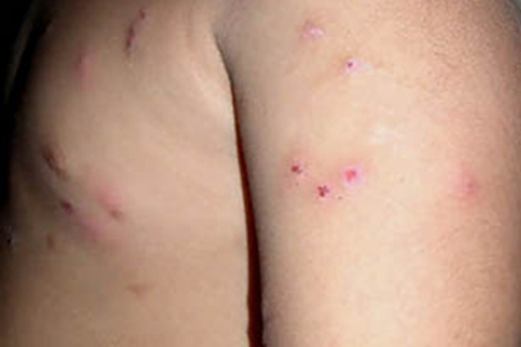 丘疹坏死性结核疹胳膊症状图