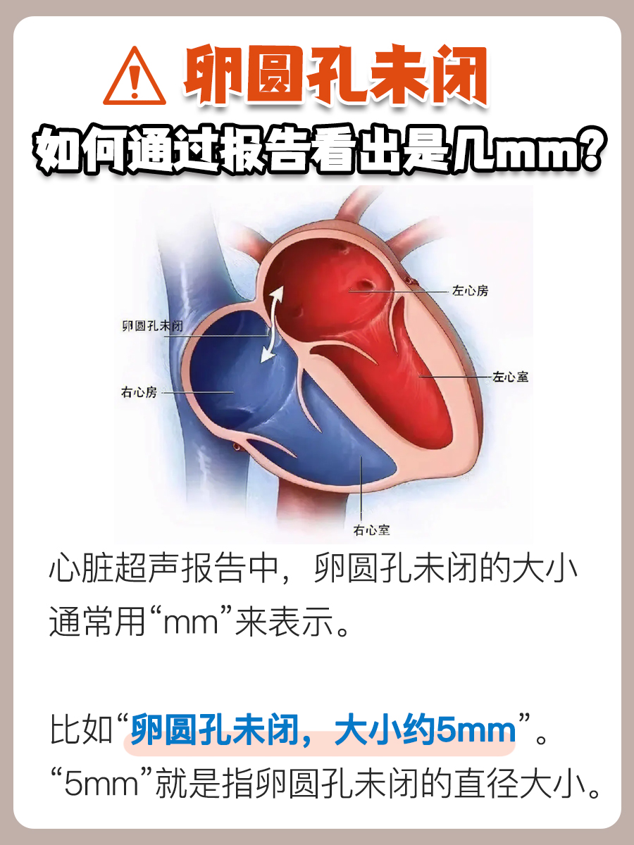 卵圆孔未闭，从报告解读mm的秘密