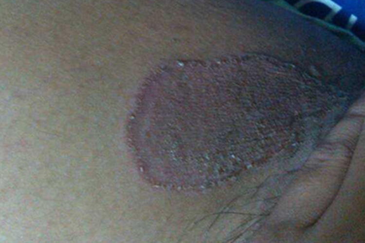 股癣大腿根部有暗红色斑图