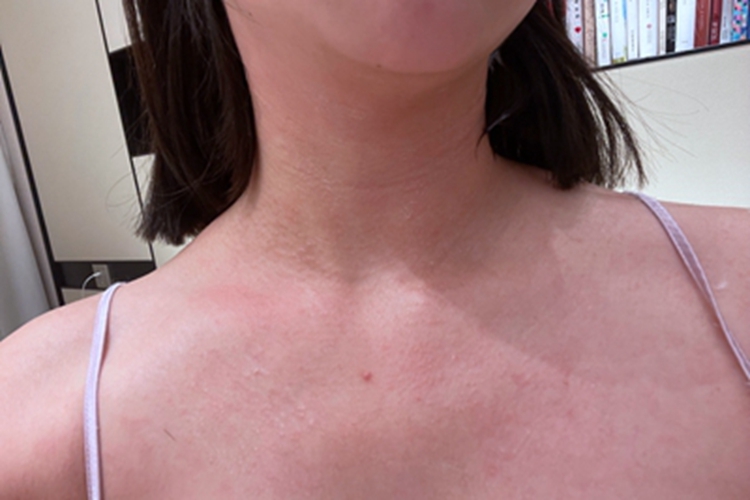 日晒伤前胸轻微发红图 日晒伤前胸轻微发红图