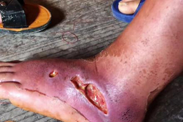 毒蛇咬伤脚部溃烂发紫图