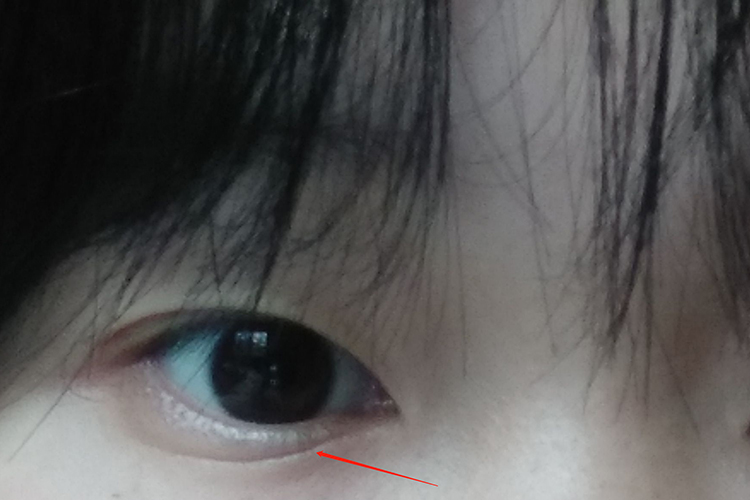 下眼睑有一条线像双眼皮图