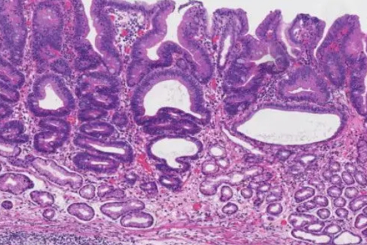 胃癌确诊报告单病理图